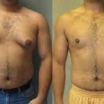 how to lose chest fat for men